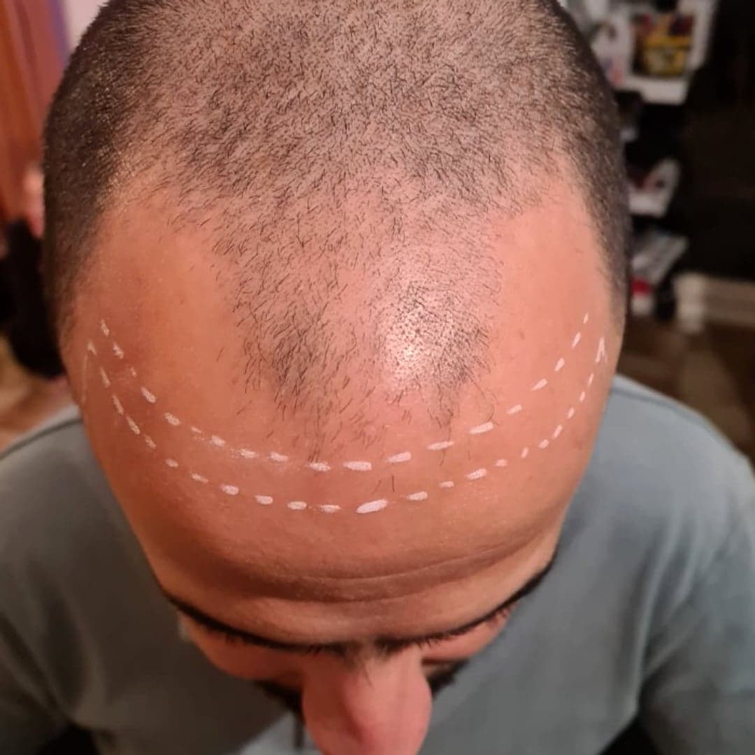 Avant tricopigmentation — étude de ligne frontale