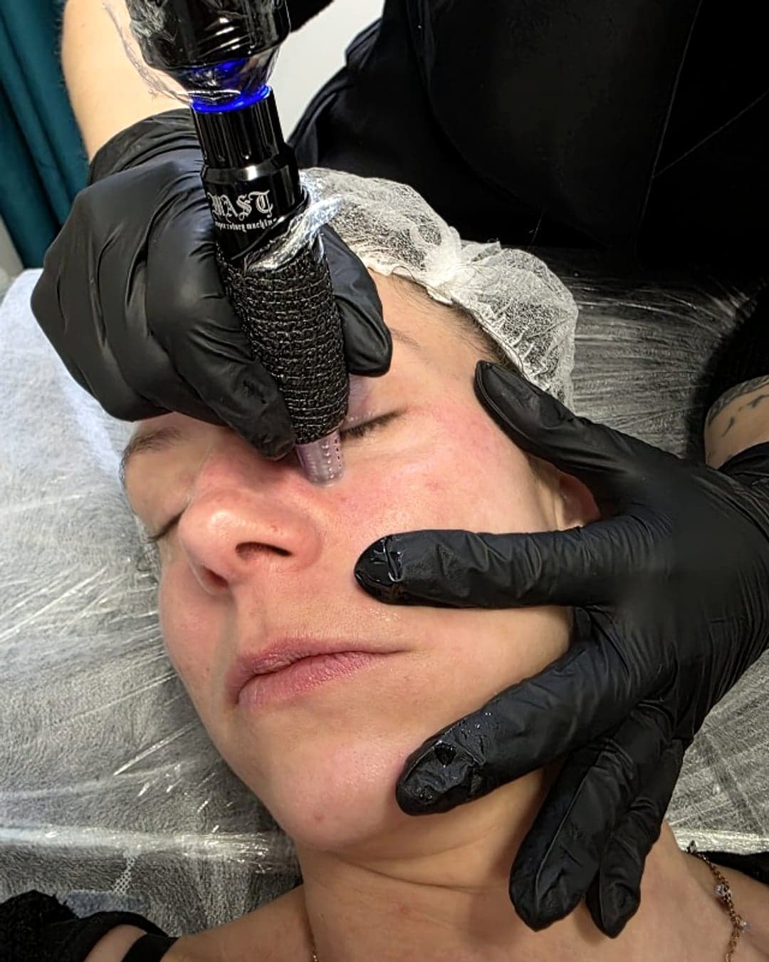 Séance de microneedling au cabinet M'Dermo